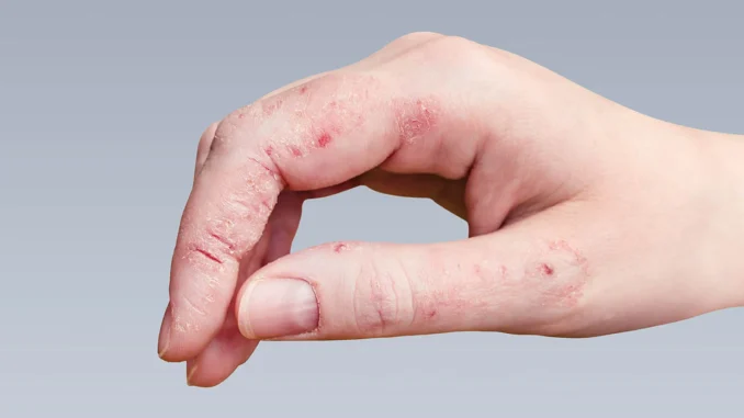 fungal-infections Найкращий засіб проти грибка: як вибрати ефективне рішення